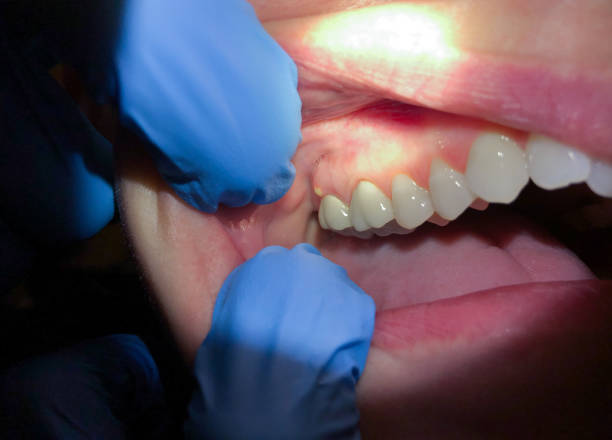 Best Emergency Tooth Extraction in Rockville, IN